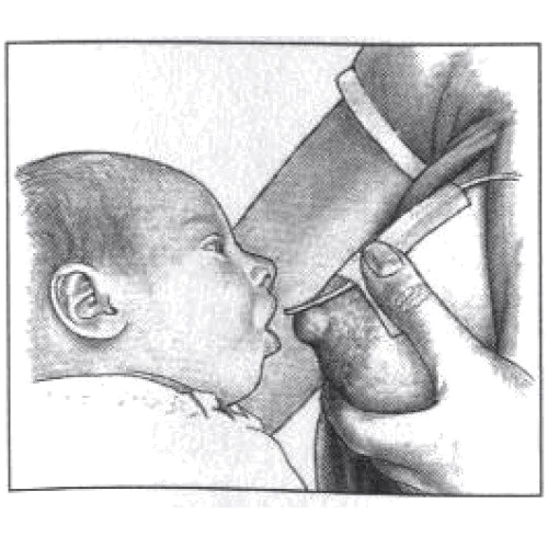 Система додаткового годування Medela (SNS) (009.0005) фото 5